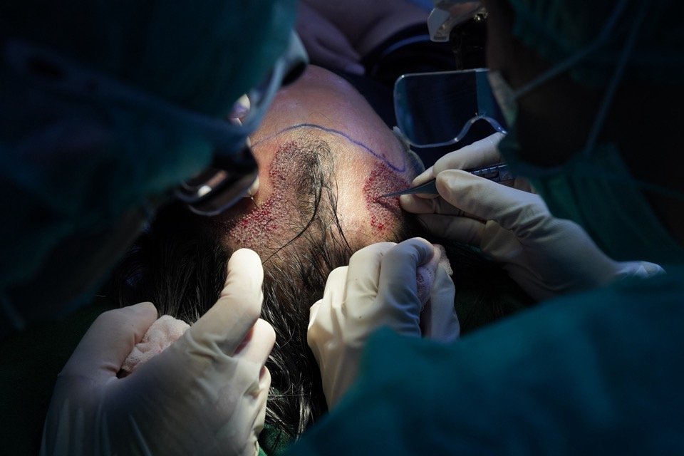 Hair transplant procedure