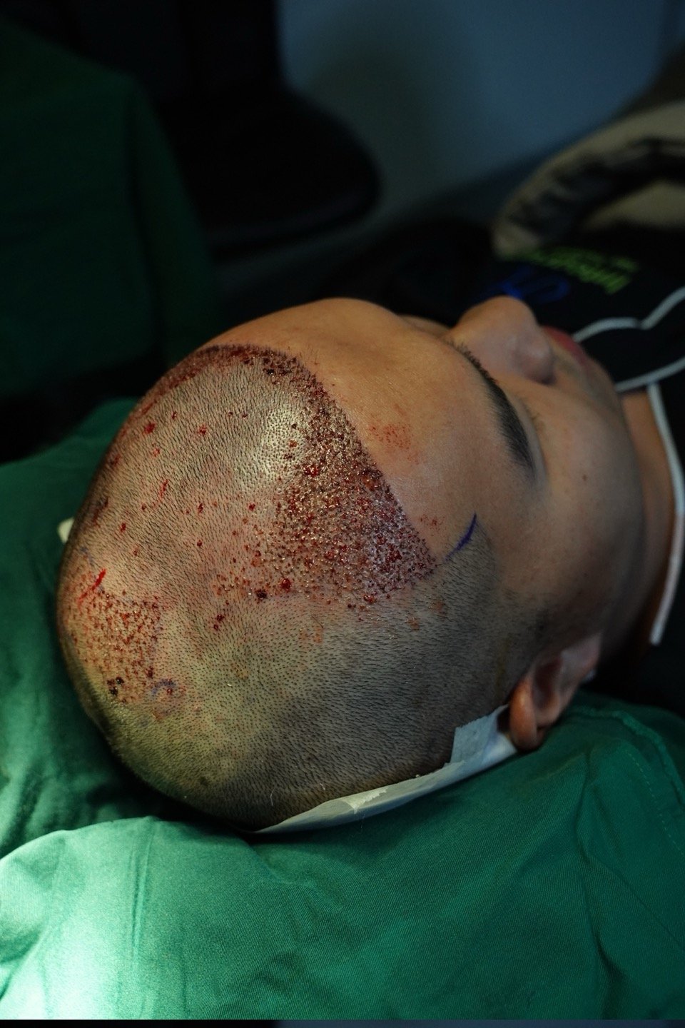 Hair implanting procedure